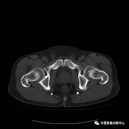 【病例】骶结节韧带钙化1例X线CT