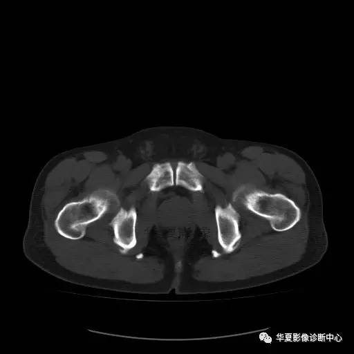 【病例】骶结节韧带钙化1例X线CT