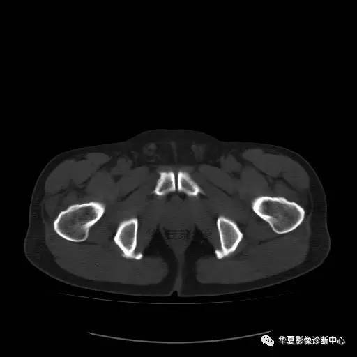 【病例】骶结节韧带钙化1例X线CT