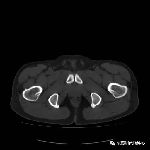 【病例】骶结节韧带钙化1例X线CT
