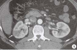 “串珠样改变”的影像诊断意义 “串珠样改变”的影像诊断意义