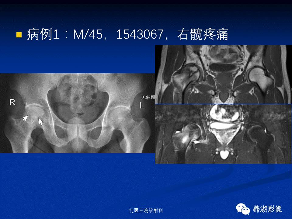 髋部疼痛：(影像)鉴别诊断