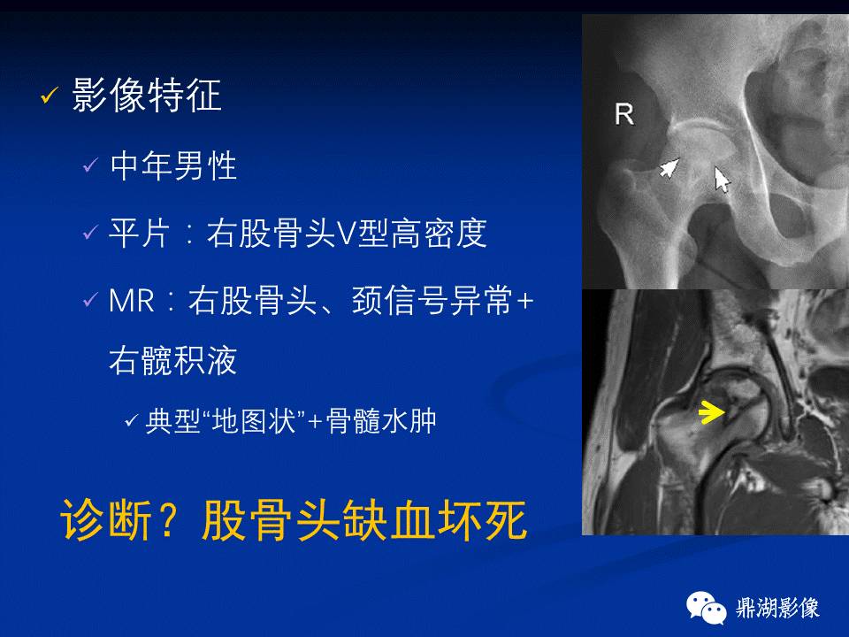 髋部疼痛：(影像)鉴别诊断