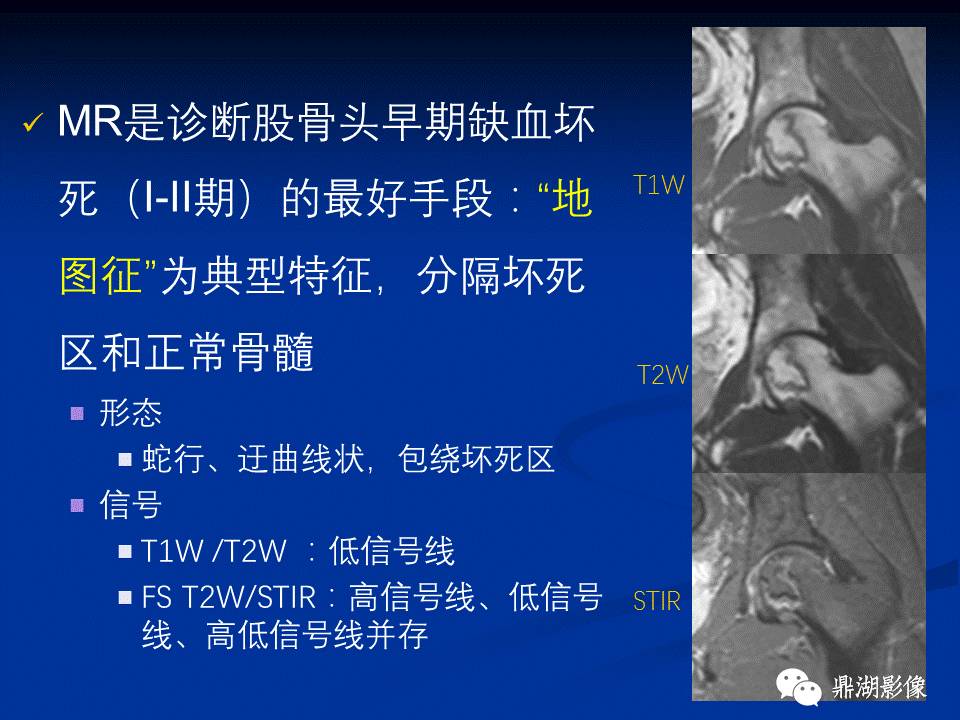 髋部疼痛：(影像)鉴别诊断