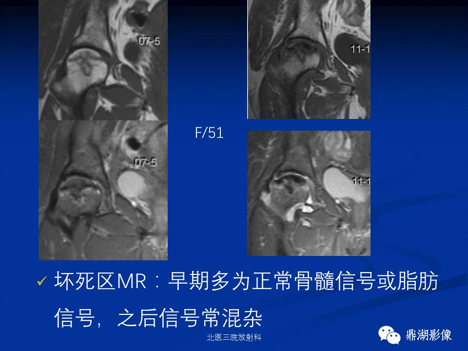 髋部疼痛：(影像)鉴别诊断