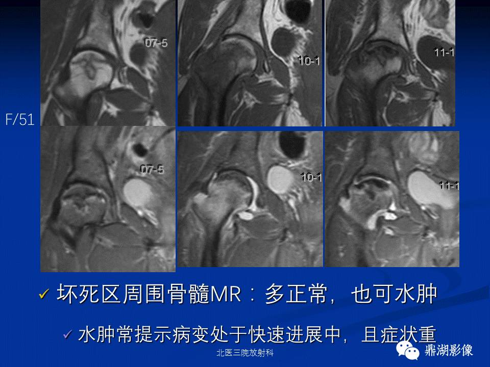 髋部疼痛：(影像)鉴别诊断