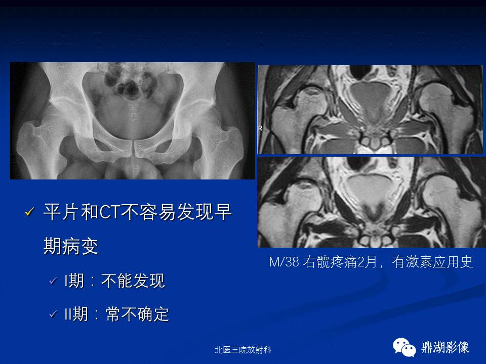 髋部疼痛：(影像)鉴别诊断