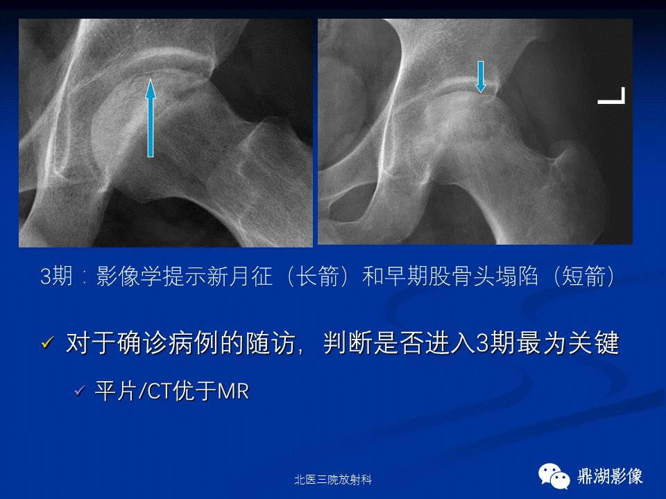 髋部疼痛：(影像)鉴别诊断