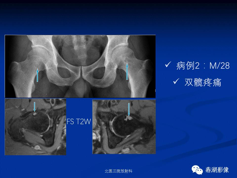 髋部疼痛：(影像)鉴别诊断
