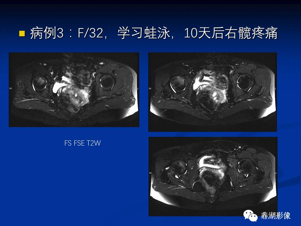 髋部疼痛：(影像)鉴别诊断