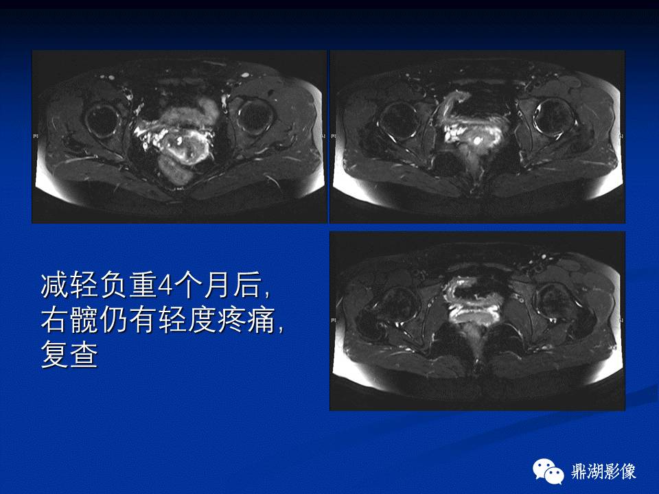 髋部疼痛：(影像)鉴别诊断
