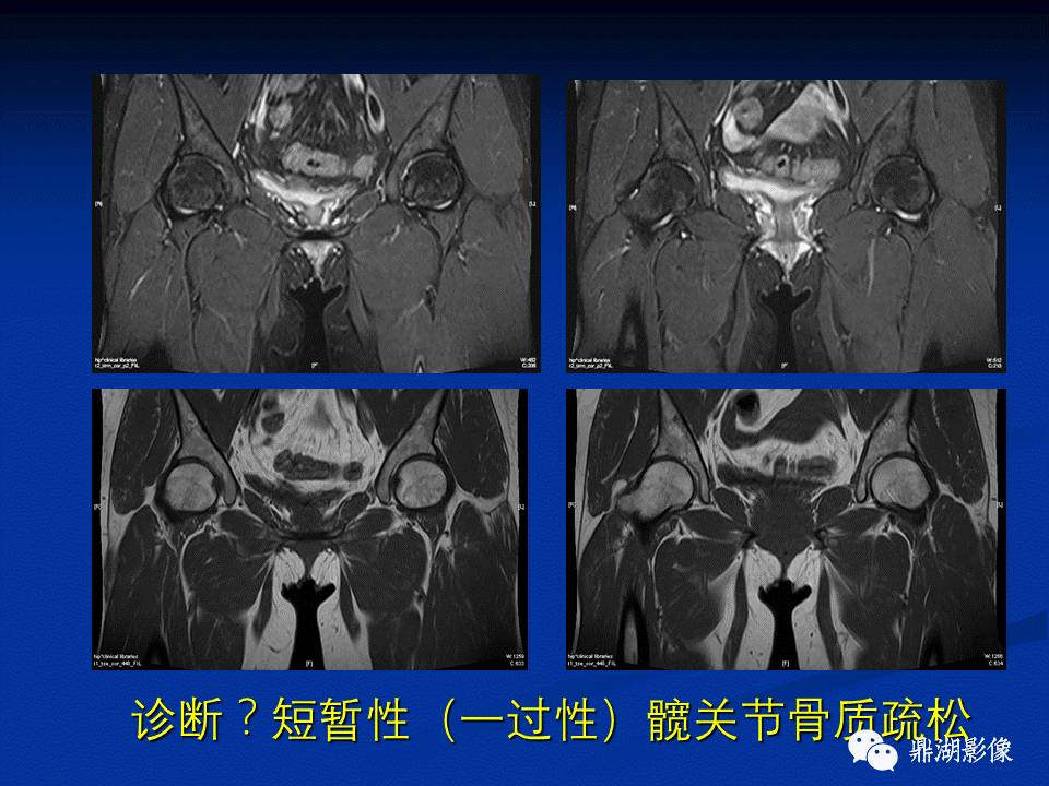 髋部疼痛：(影像)鉴别诊断