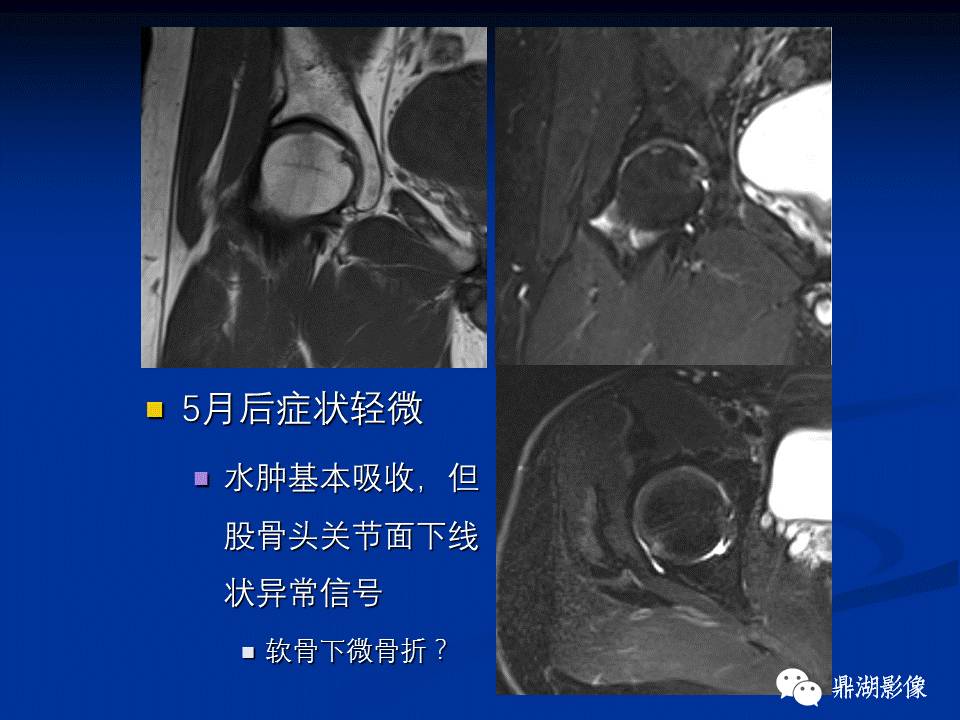 髋部疼痛：(影像)鉴别诊断