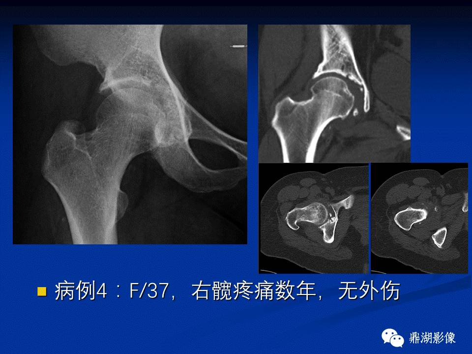 髋部疼痛：(影像)鉴别诊断
