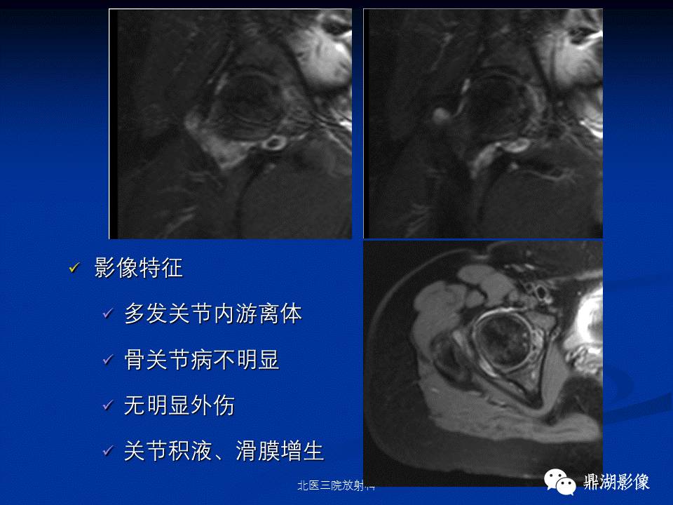 髋部疼痛：(影像)鉴别诊断