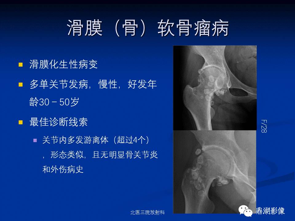 髋部疼痛：(影像)鉴别诊断