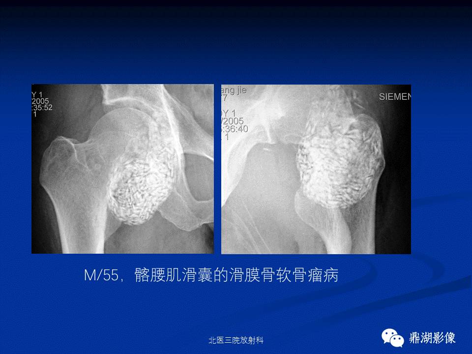 髋部疼痛：(影像)鉴别诊断
