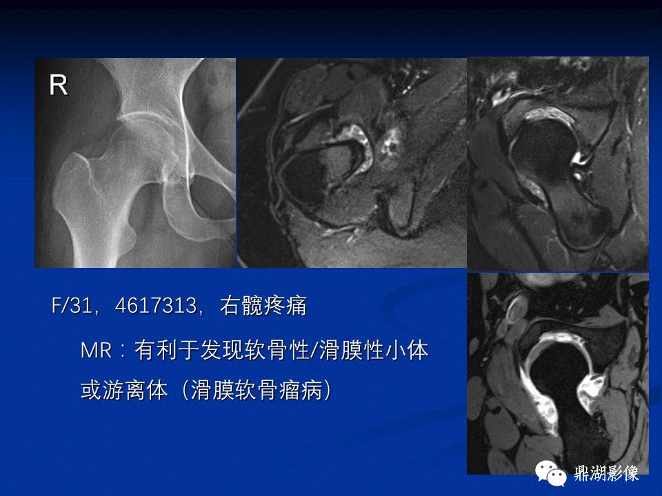 髋部疼痛：(影像)鉴别诊断
