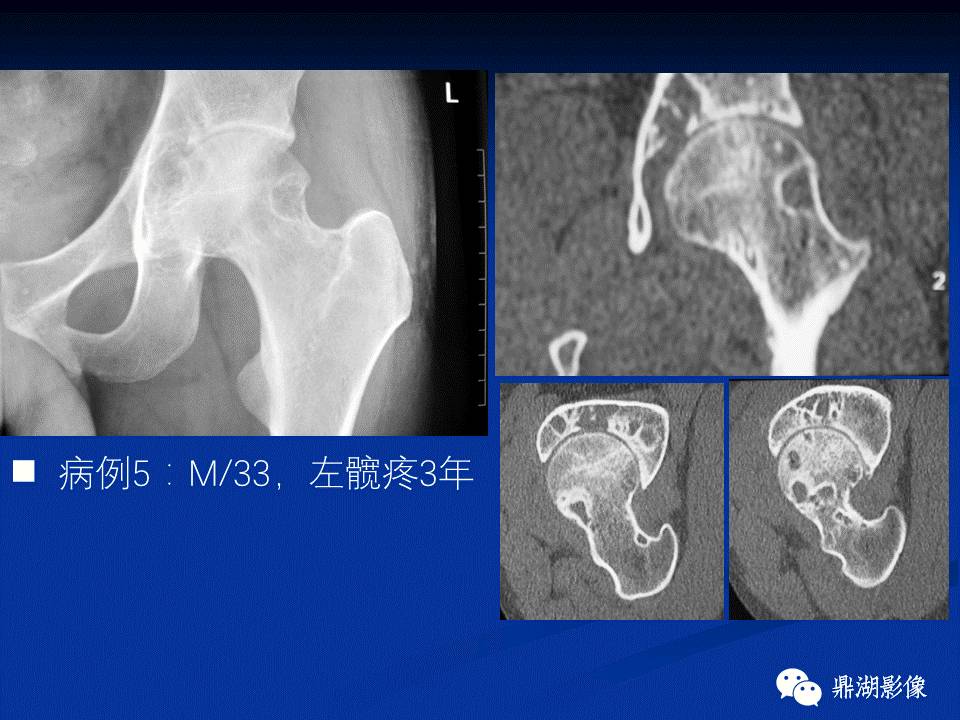 髋部疼痛：(影像)鉴别诊断