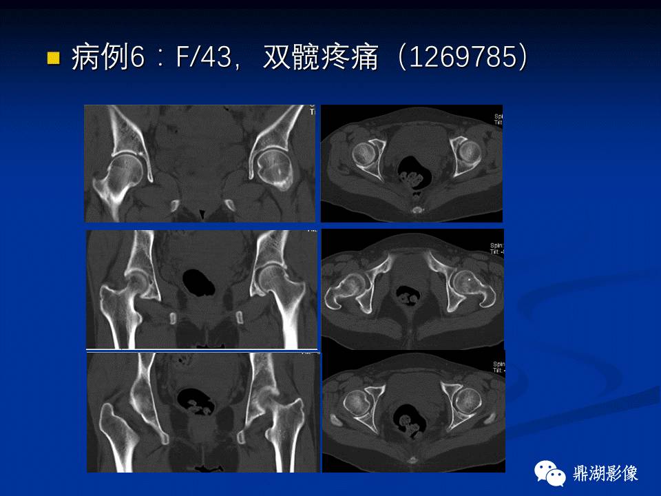 髋部疼痛：(影像)鉴别诊断