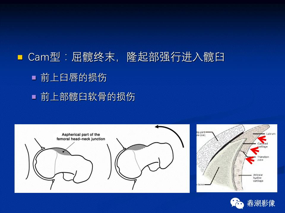 髋部疼痛：(影像)鉴别诊断