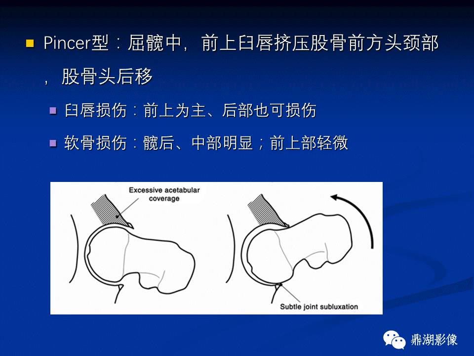 髋部疼痛：(影像)鉴别诊断