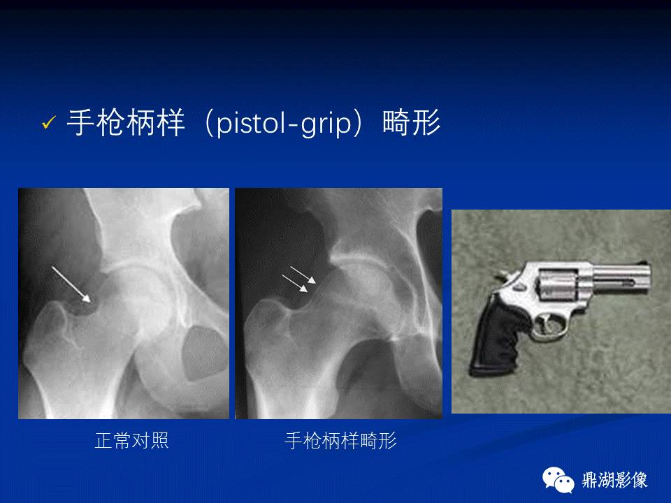 髋部疼痛：(影像)鉴别诊断