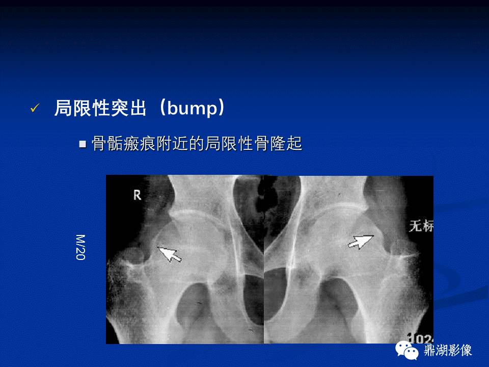 髋部疼痛：(影像)鉴别诊断