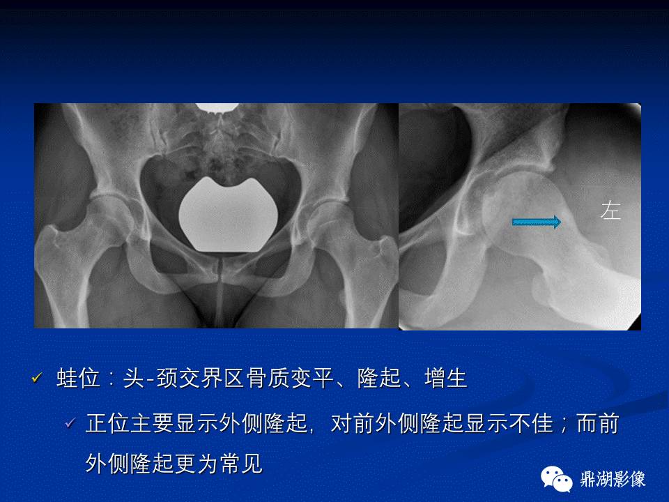 髋部疼痛：(影像)鉴别诊断