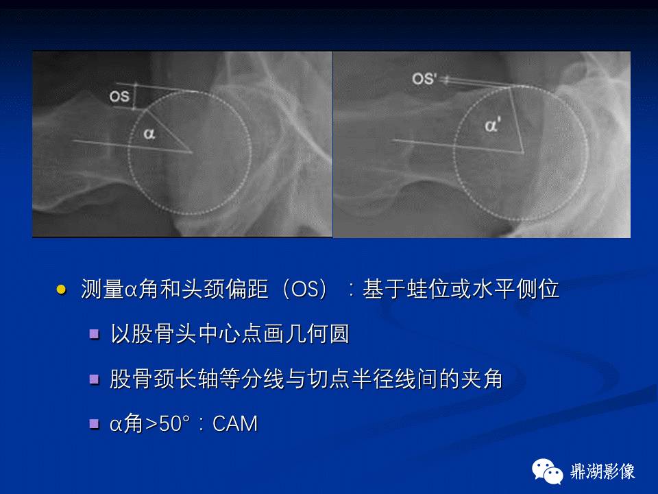 髋部疼痛：(影像)鉴别诊断