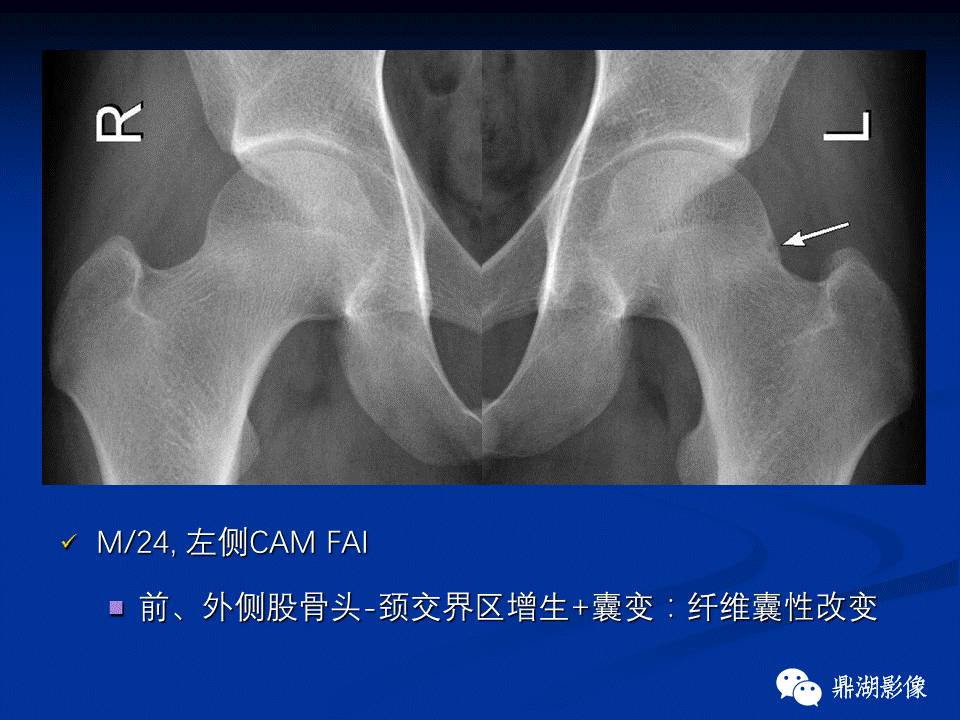 髋部疼痛：(影像)鉴别诊断