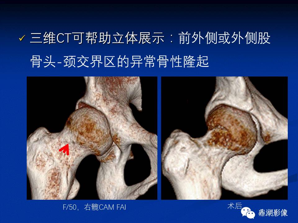 髋部疼痛：(影像)鉴别诊断