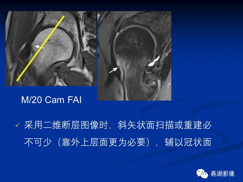 髋部疼痛：(影像)鉴别诊断