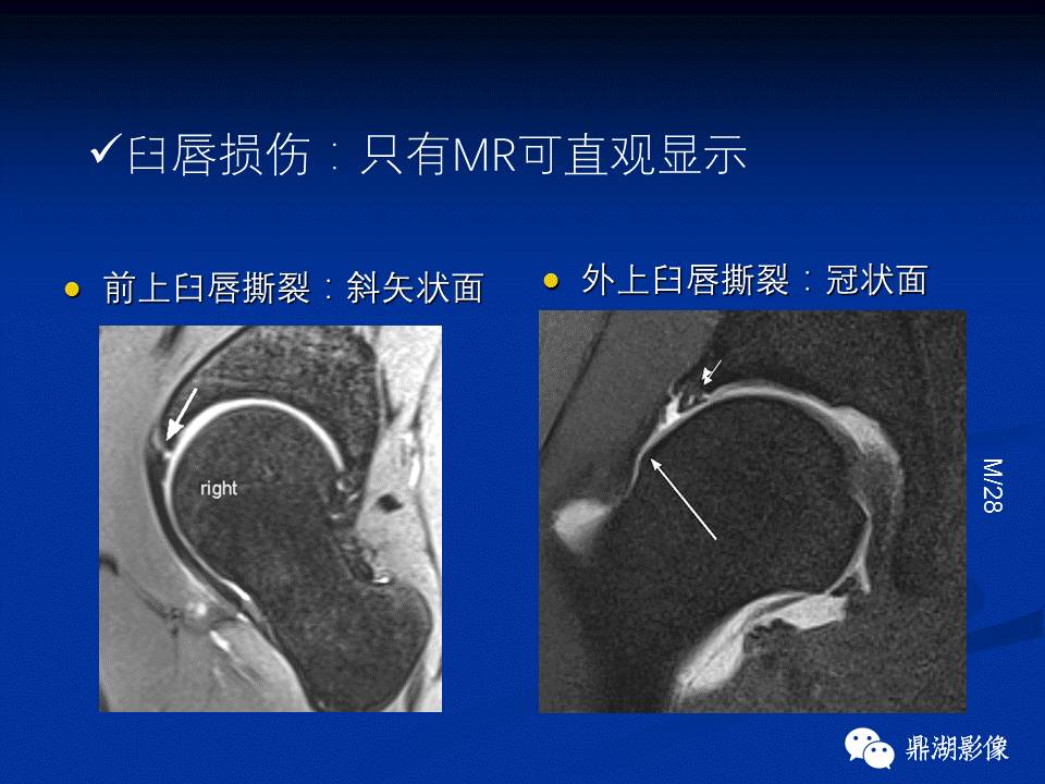 髋部疼痛：(影像)鉴别诊断