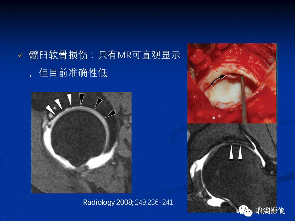 髋部疼痛：(影像)鉴别诊断