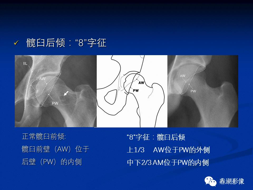 髋部疼痛：(影像)鉴别诊断
