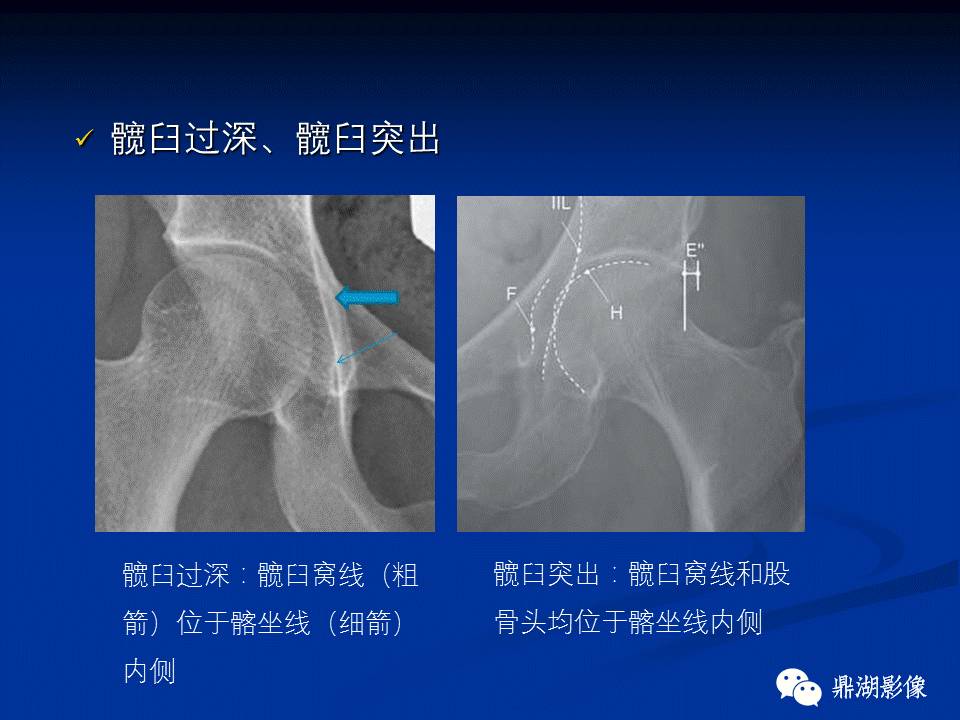 髋部疼痛：(影像)鉴别诊断