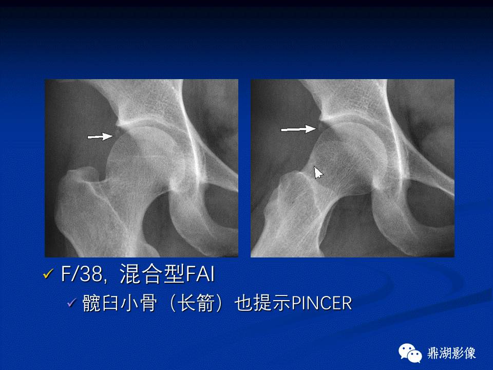 髋部疼痛：(影像)鉴别诊断
