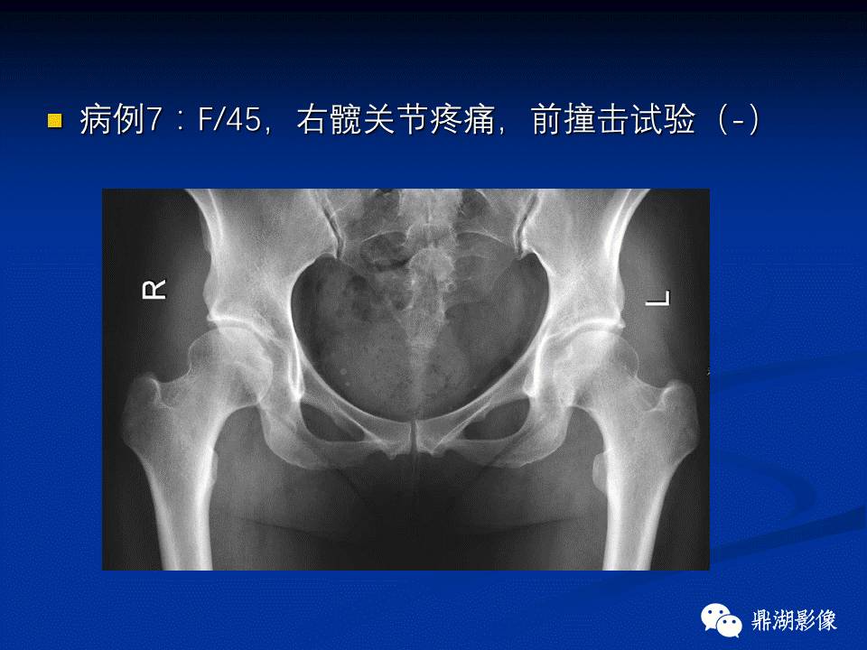 髋部疼痛：(影像)鉴别诊断