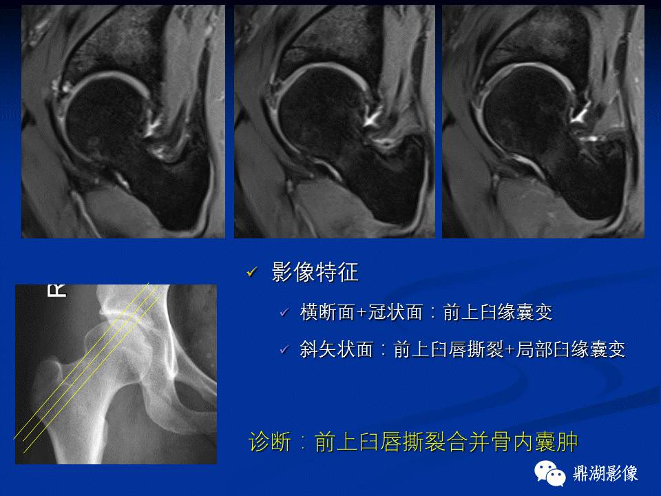 髋部疼痛：(影像)鉴别诊断