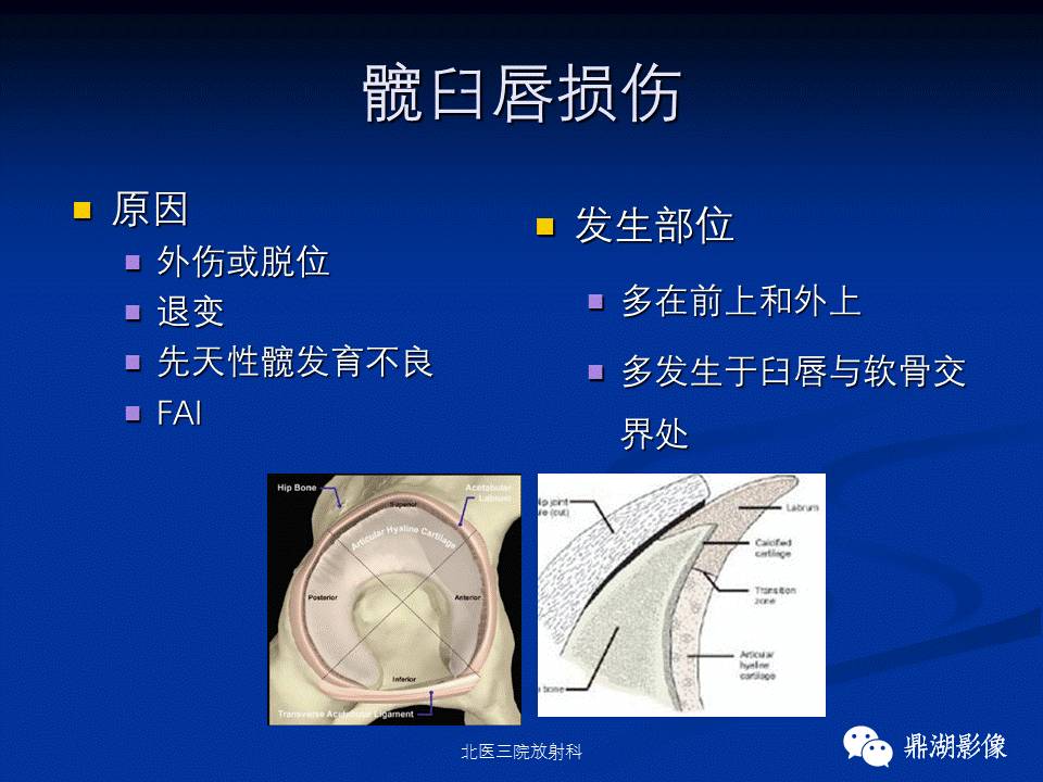 髋部疼痛：(影像)鉴别诊断