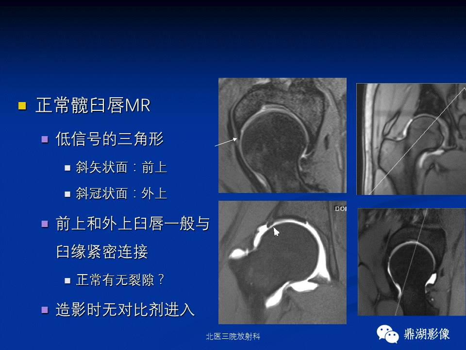 髋部疼痛：(影像)鉴别诊断