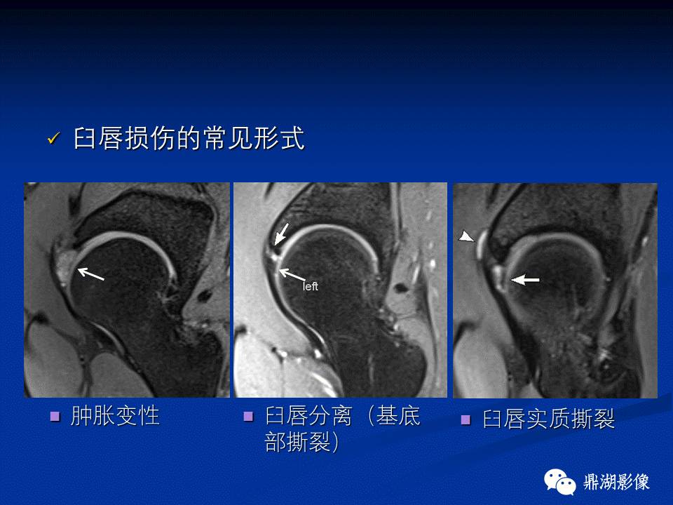 髋部疼痛：(影像)鉴别诊断