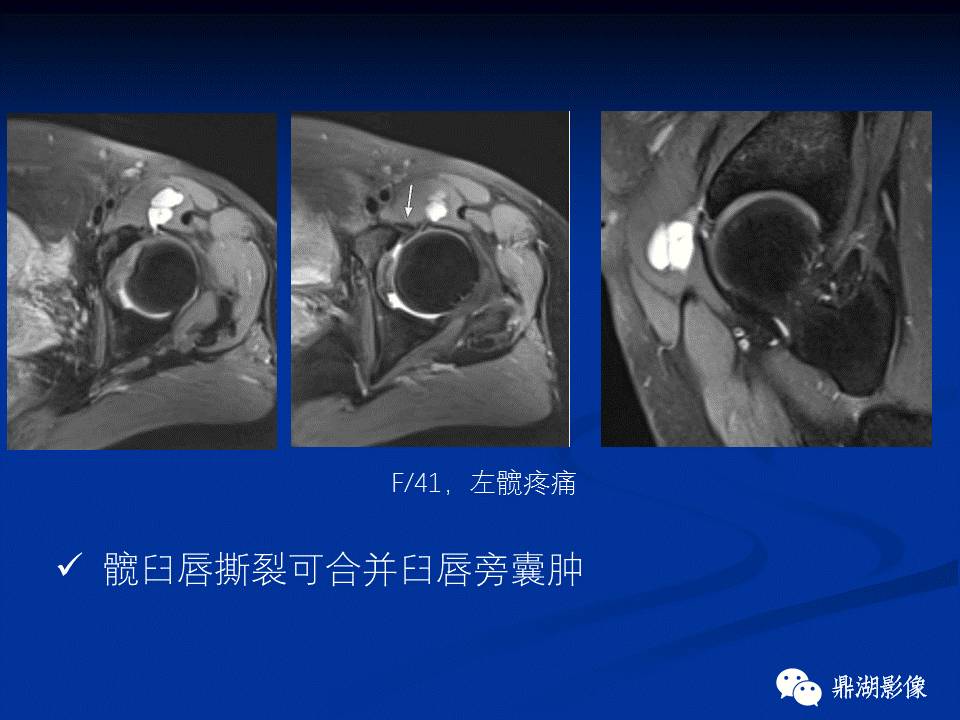 髋部疼痛：(影像)鉴别诊断