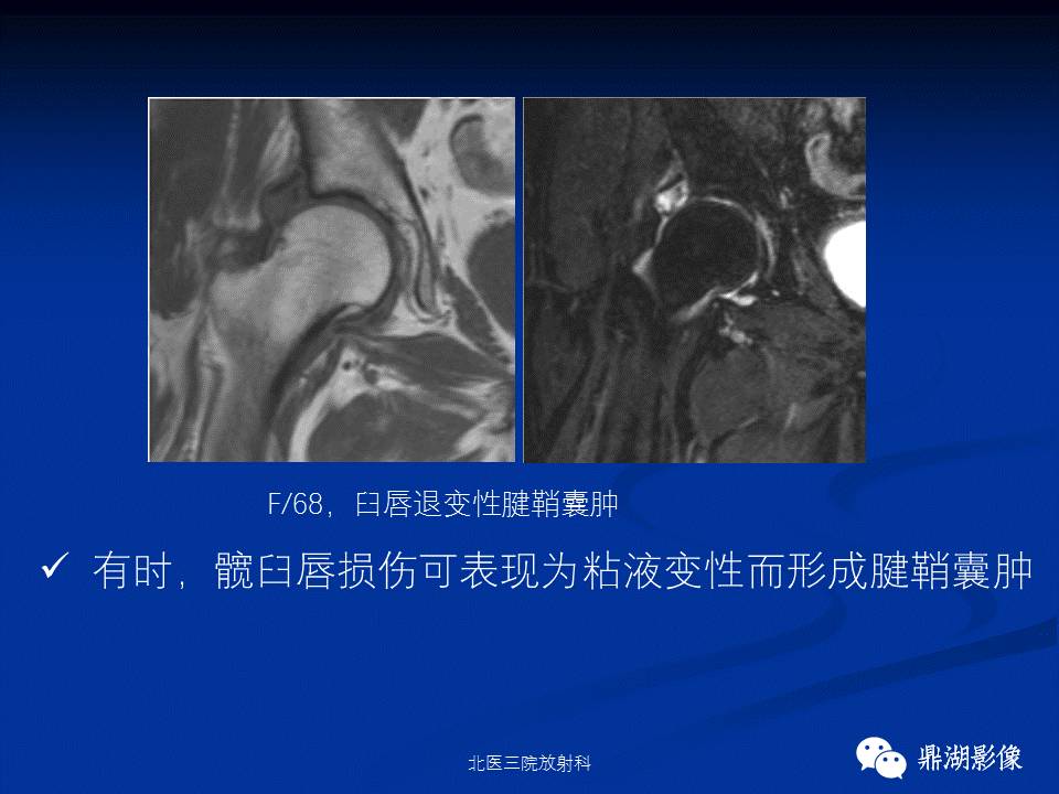髋部疼痛：(影像)鉴别诊断