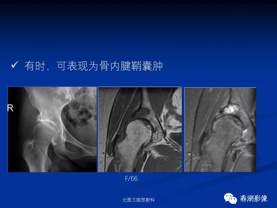 髋部疼痛：(影像)鉴别诊断