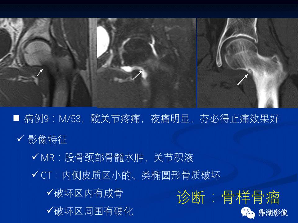 髋部疼痛：(影像)鉴别诊断