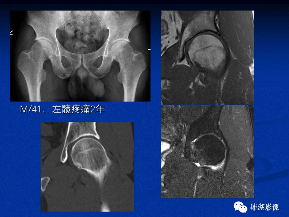 髋部疼痛：(影像)鉴别诊断