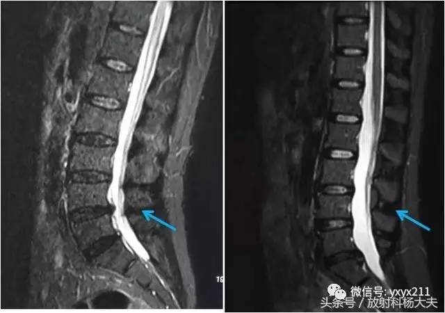 腰痛患者MRI未见椎间盘突出,你还要注意这个疾病! 腰痛患者MRI未见椎间盘突出,你还要注意这个疾病!