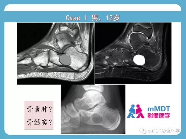 【PPT】跗骨病变影像分析思路(续)